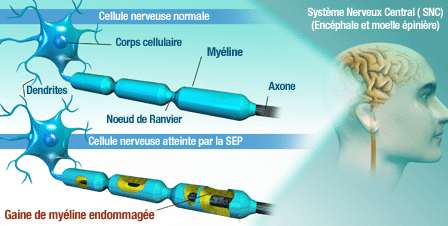 Symptômes sclerose plaques