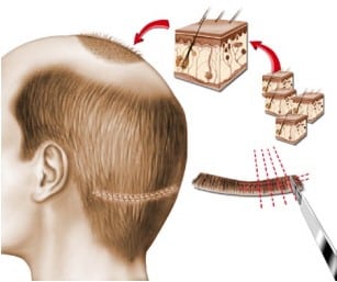 micro-greffe-lyon-esthetique Micro-greffe Lyon esthétique